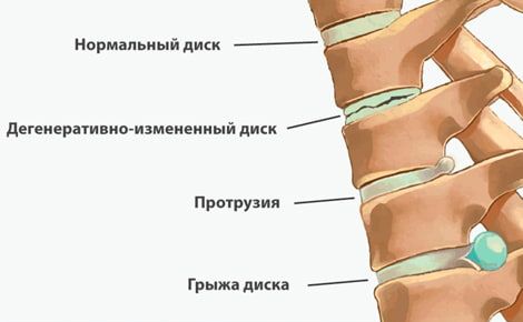 Грыжа: боль в ноге и спине - Доктор Позвонков