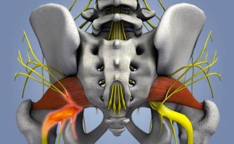 Ишиас: причины, симптомы, лечение
